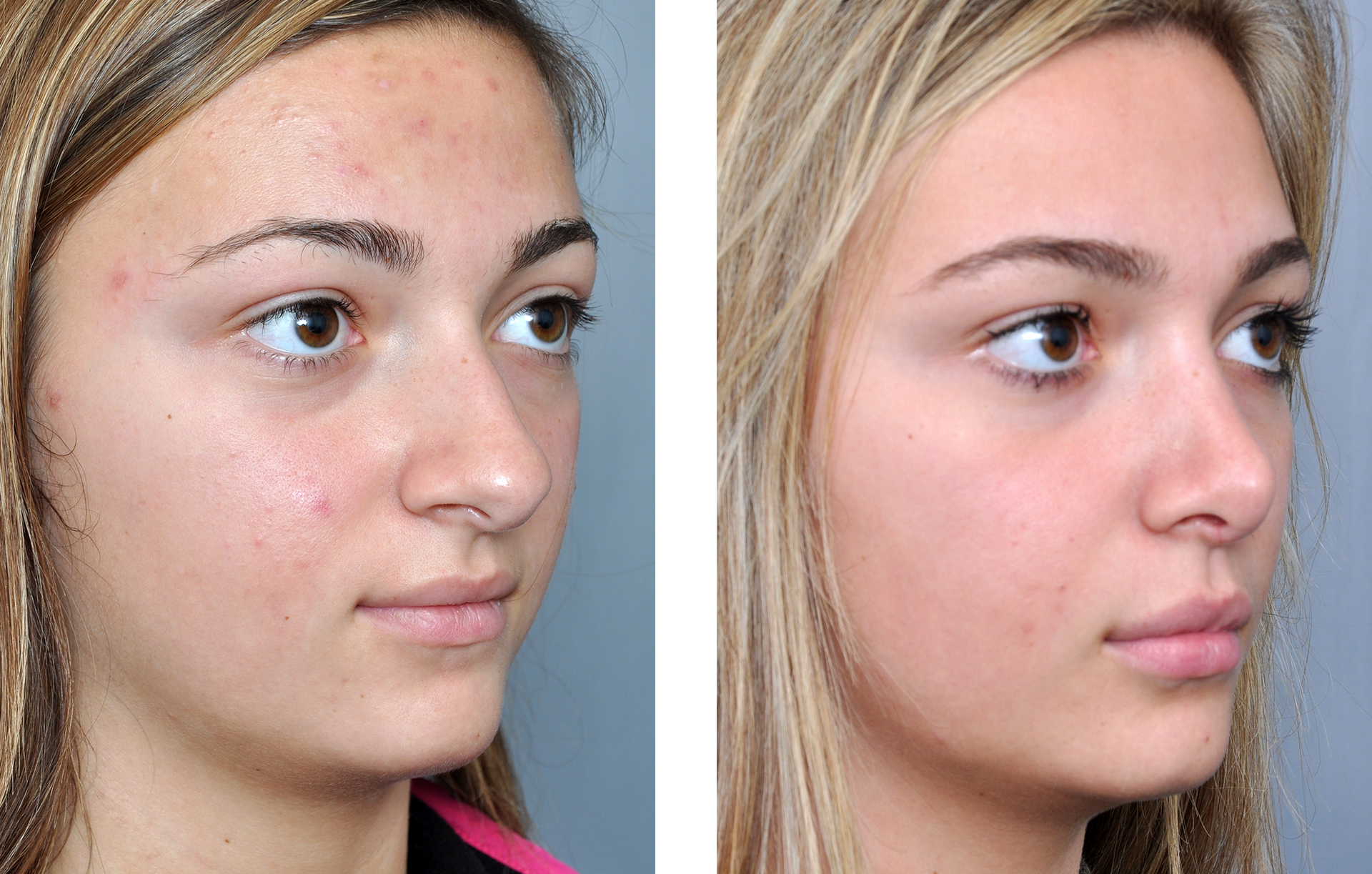 Before and after photos of a person's face; nose appears smaller and straighter in after photo.