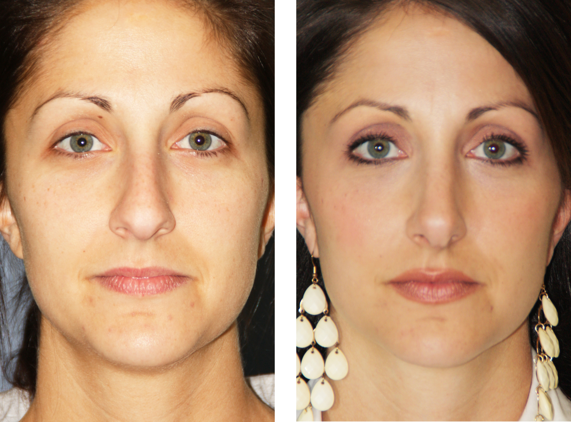 Before and after photos of a woman's face, possibly showing cosmetic improvements.
