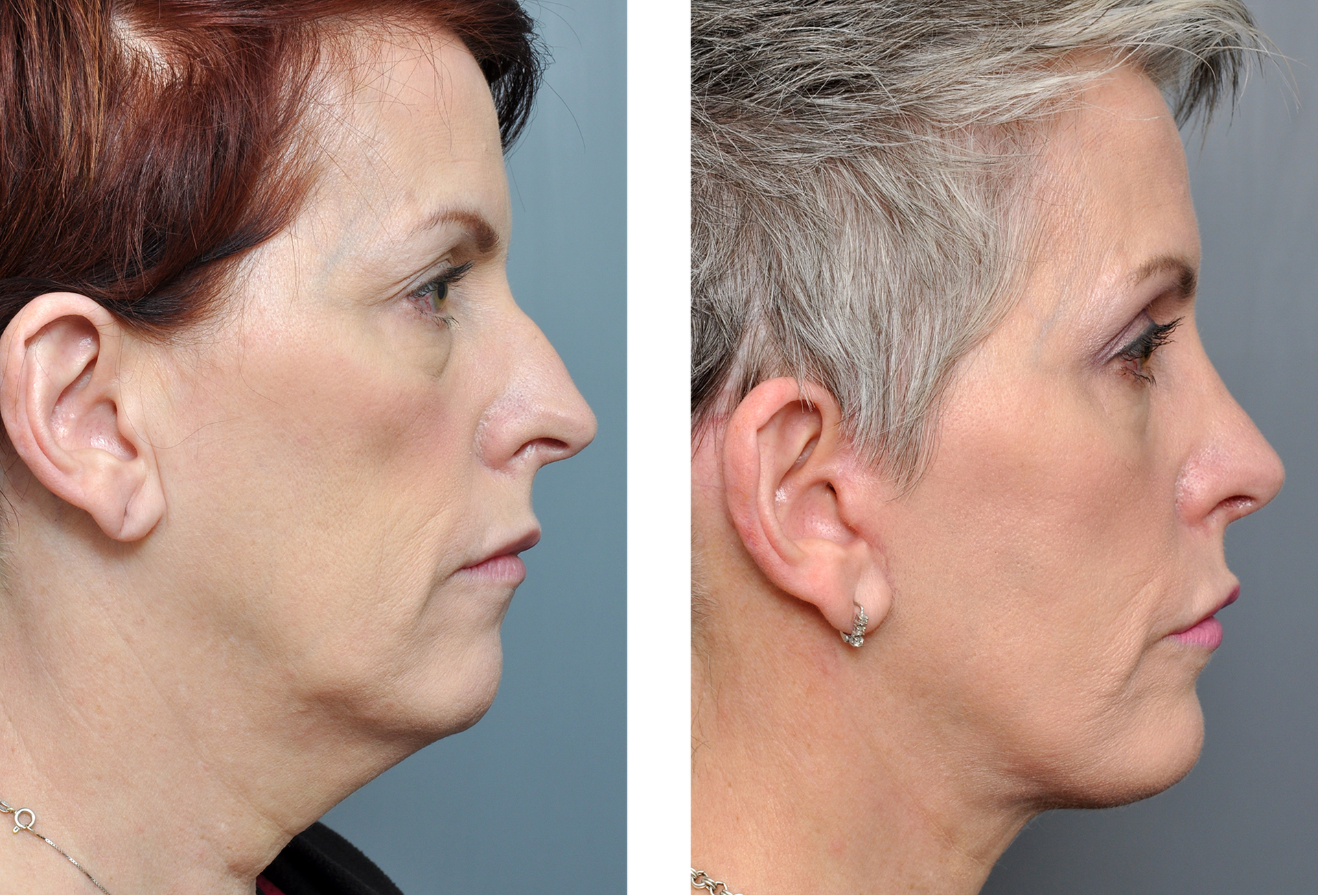 Before and after side profile of a person; shows changes in neck and jawline after cosmetic procedure.