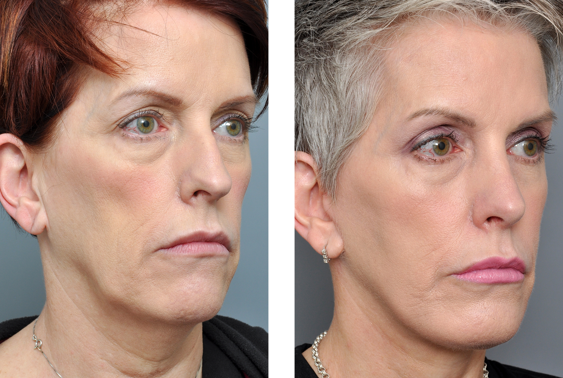 Before-and-after photos: woman with drooping jowls and a neck lift, appearing more youthful.