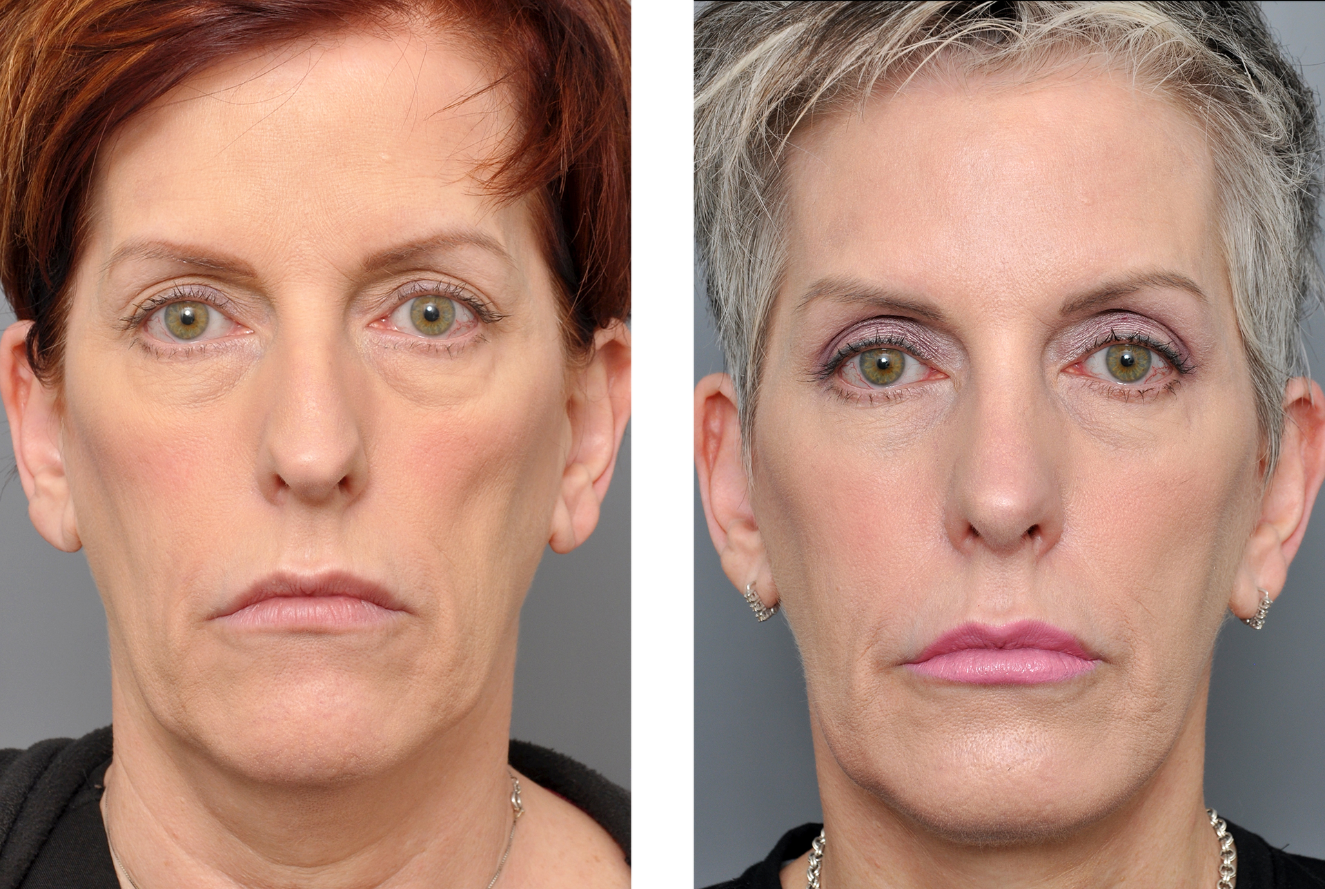 Before and after photos of a woman's face, showing cosmetic facial surgery results.
