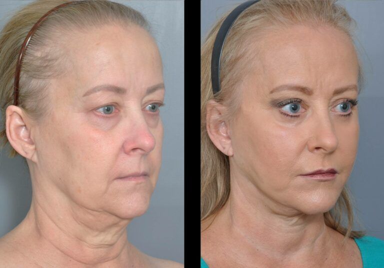 Before and after photos of a person's face; post-surgery, skin is tighter, and wrinkles are diminished.