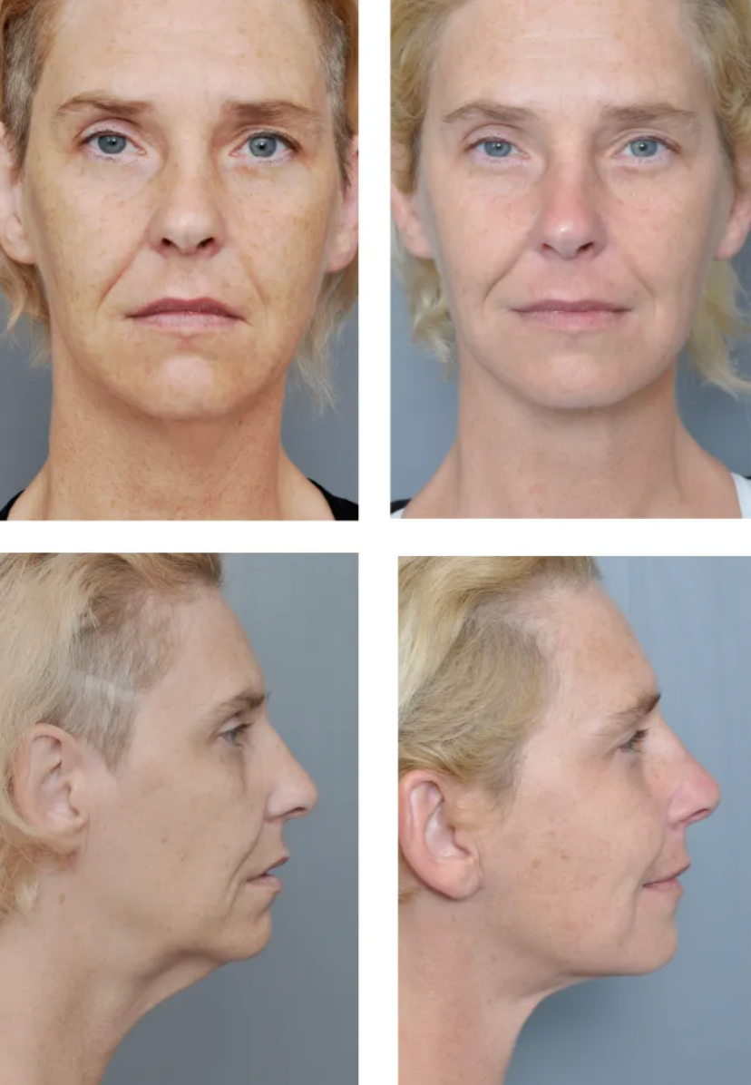 Before and after photos showing a neck lift. The after photo shows a tighter, smoother neck.