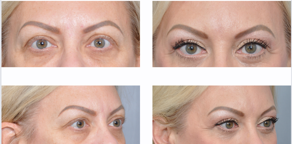 Before and after images of a woman's eyes. Top: frontal view. Bottom: side view.  Eyes look more open in the 