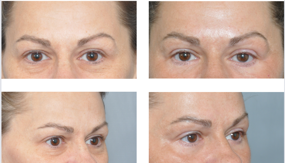 Before and after views of a person's eyes, showing a brow lift procedure.