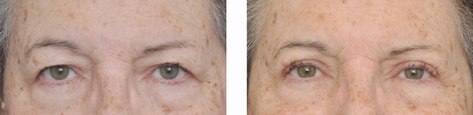 Before and after photos of a person's eyes, showing a lifted brow and reduced eyelid droop.