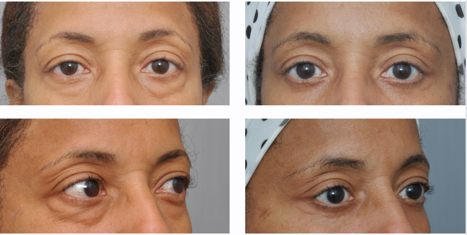 Four views of eyes; before and after photos. Shows eyelids with less sagging post-procedure.