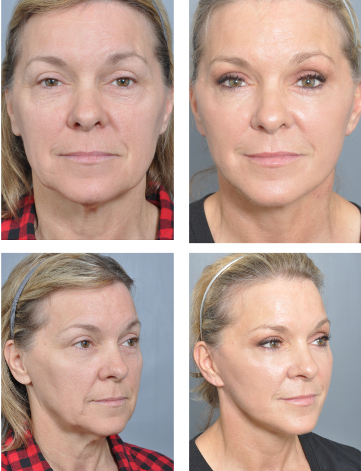 Before and after photos of a woman's face, showing improvement after a cosmetic procedure.