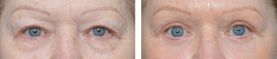 Before and after photos showing a person's eyes, likely after an eyelid procedure.