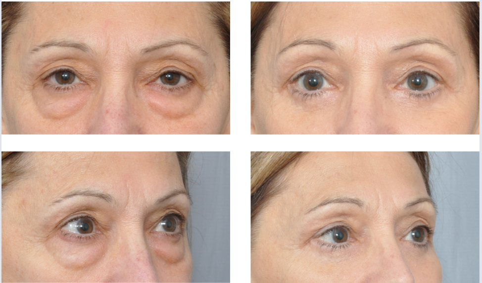 Before and after photos showing reduced under-eye bags and smoother skin around the eyes.