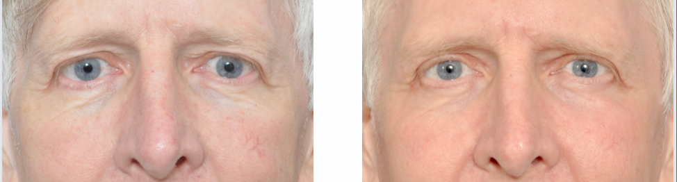 Close-up of a person's eyes and nose. The person has fair skin and light blue eyes.
