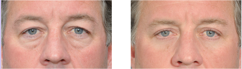 Before and after of a person's eyes, showing a cosmetic procedure. The 