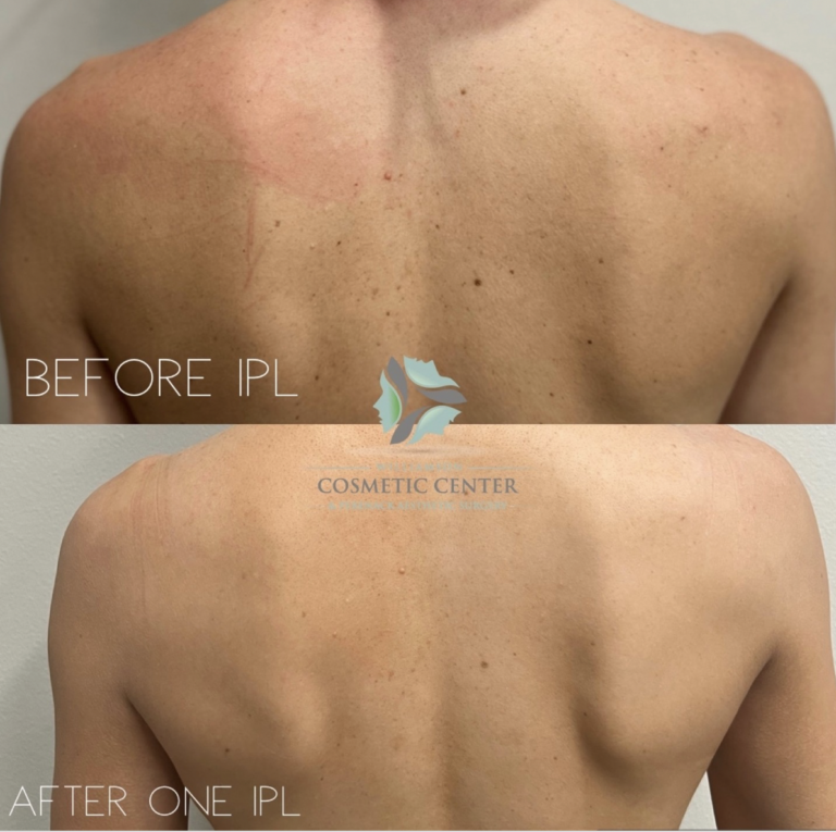 Back view of a person before and after IPL treatment. The skin appears lighter and smoother after one session.
