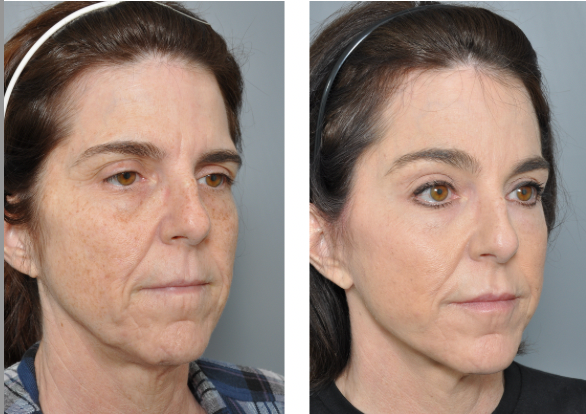 Before and after photos of facelift at Williamson Cosmetic Center