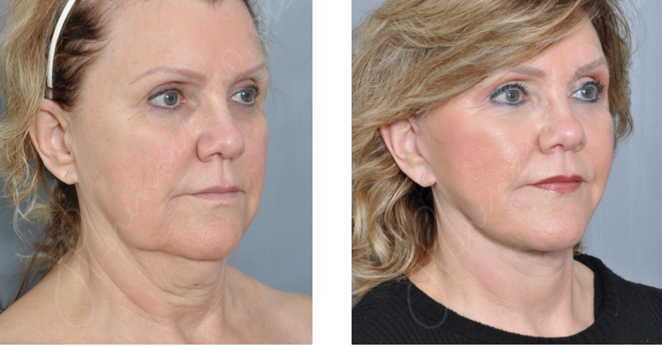 Before and after photos of facelift at Williamson Cosmetic Center