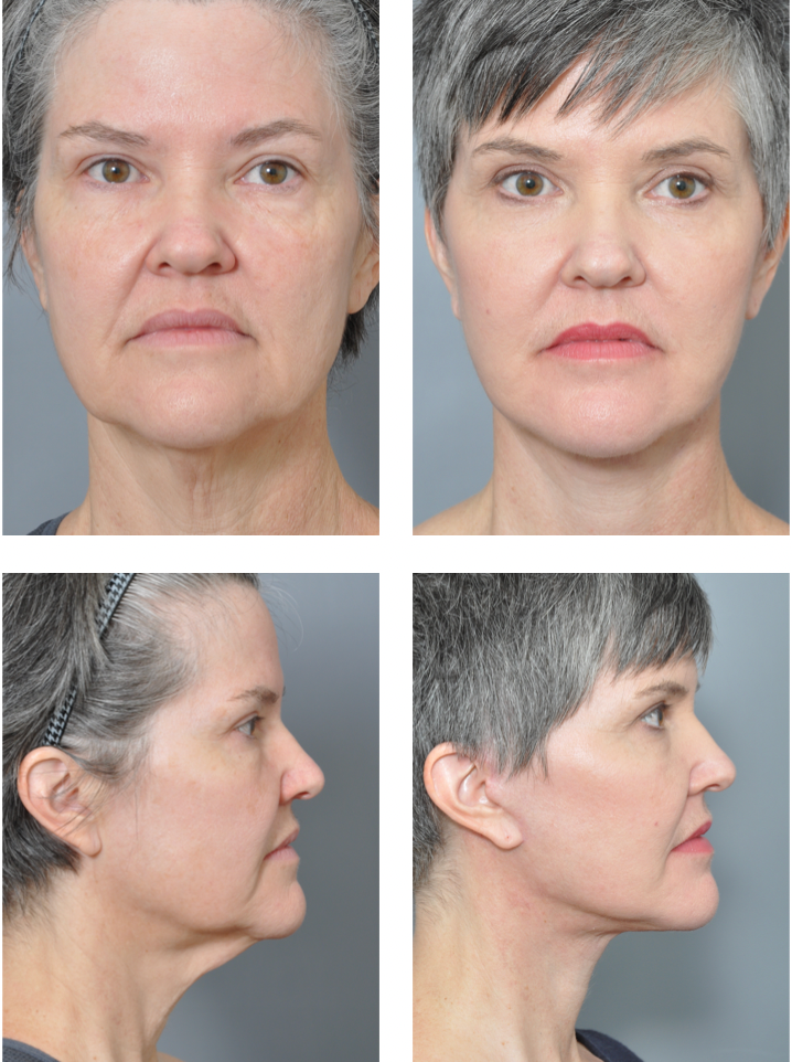 Before and after photos of a person's face; frontal and side views showing facelift results.