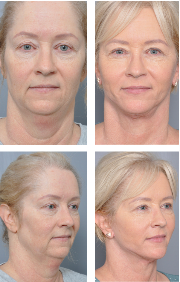 Before and after view of a person's face after cosmetic surgery. Shows facial lift and neck tightening.