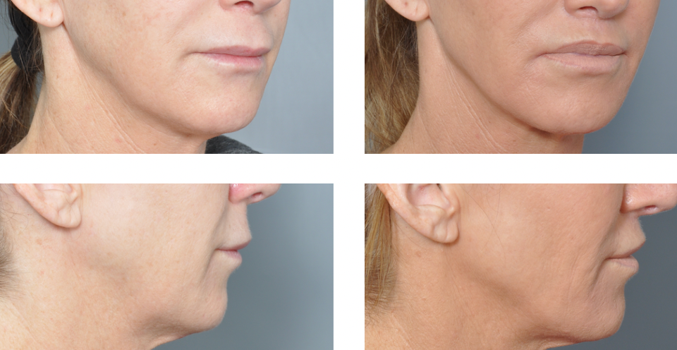 Four views of a person's lower face and neck, before and after a cosmetic procedure.