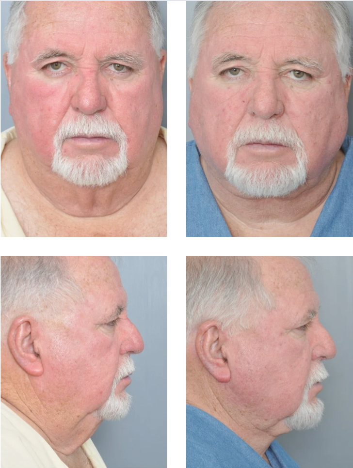 Four-panel comparison of a man's face before and after treatment, showing changes in swelling and jawline definition.