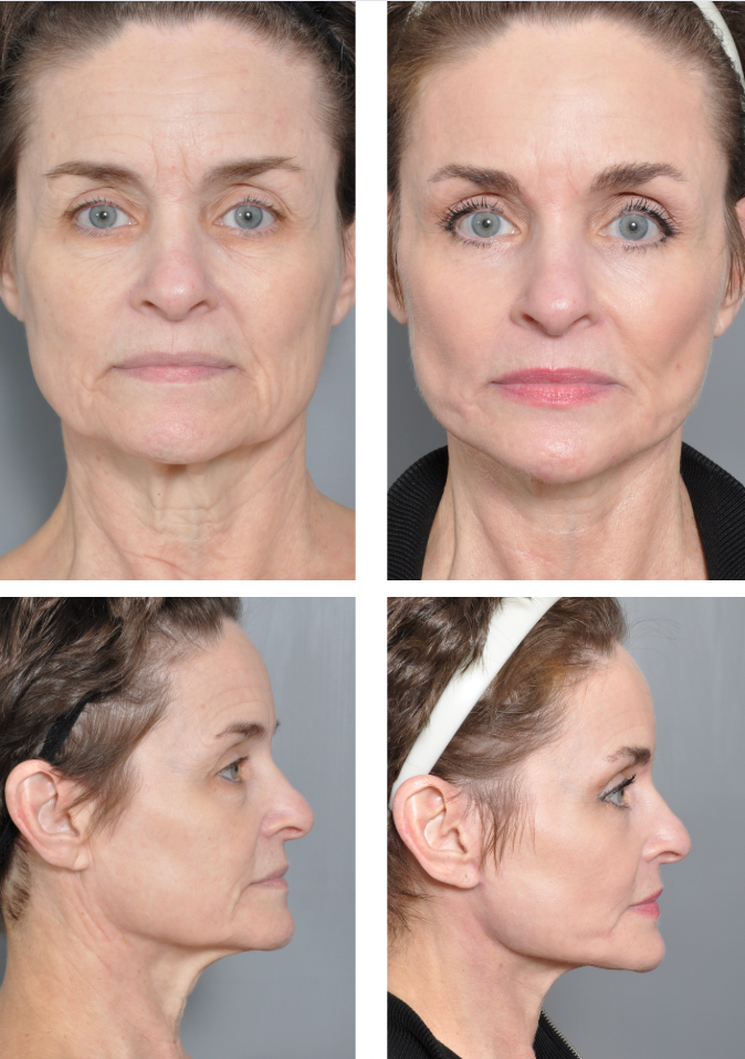 Before-and-after photos of a woman's face and neck, showing wrinkles reduced after a cosmetic procedure.