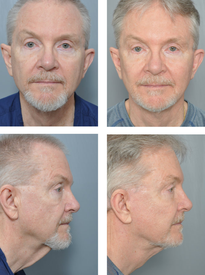 Before and after photos showing an adult male with prominent ears, and his ears now closer to his head.