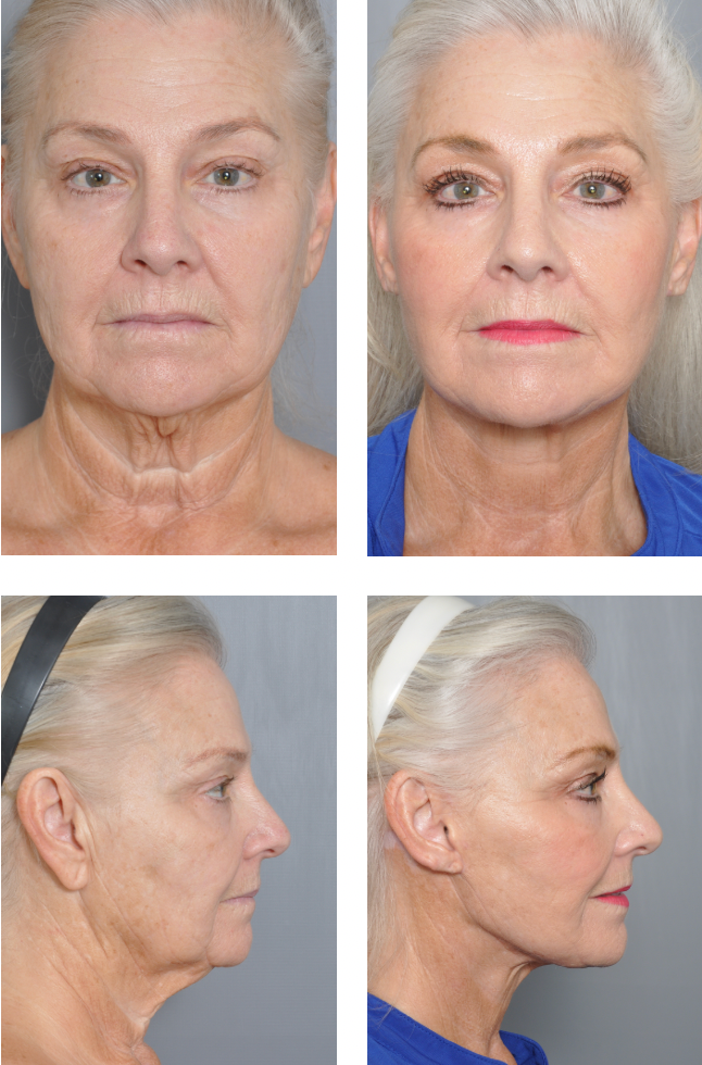 Before-and-after facial rejuvenation photos. Front and side views of a woman with reduced wrinkles and sagging.