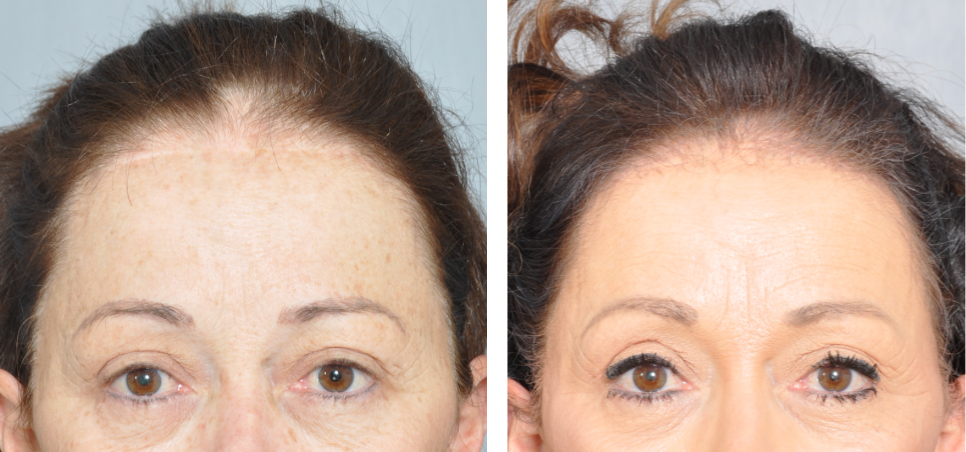 Before and after comparison showing improved hair density. Woman's forehead and eyes are visible.