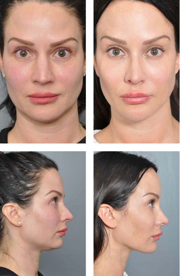 Before and after photos showing facial cosmetic procedure results; front and side views.