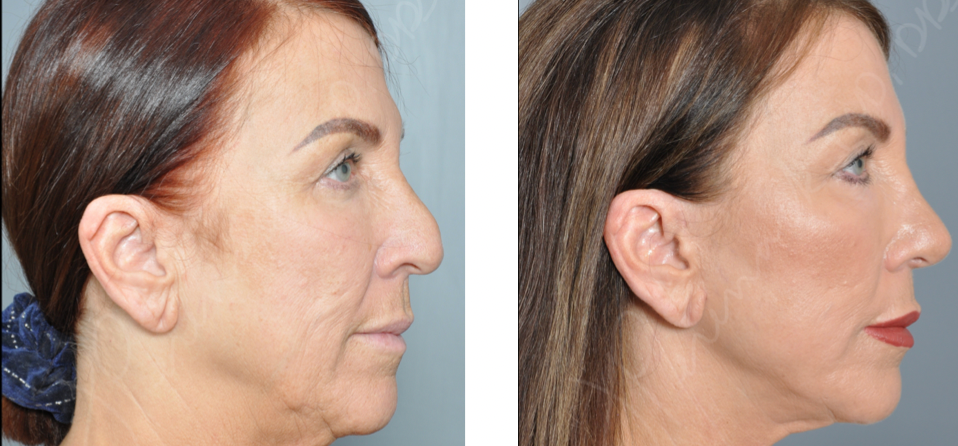 Williamson Cosmetic Center - rhinoplasty gallery