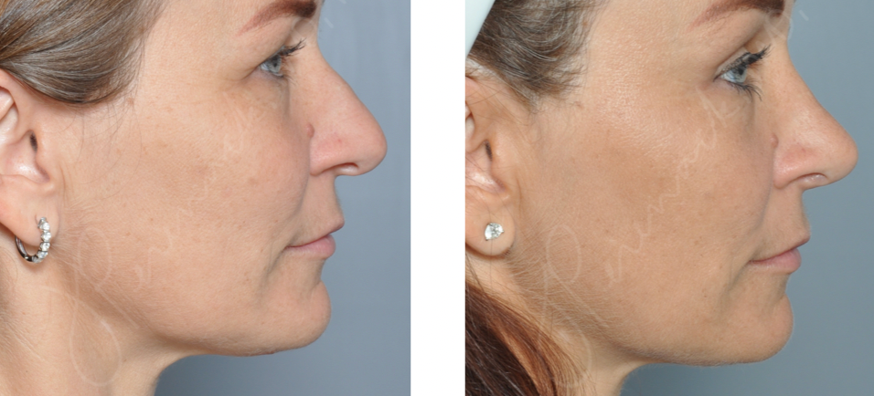 Before and after views of a woman's face, likely showing cosmetic surgery results, profile.