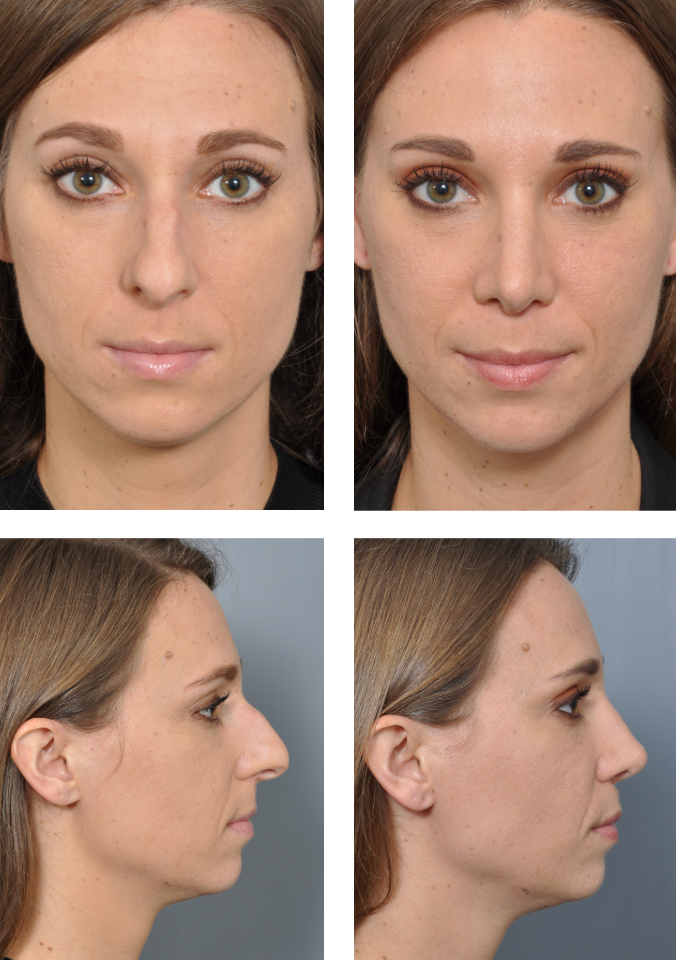 Before and after frontal and side views of a woman's nose, showcasing rhinoplasty results.