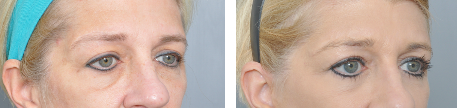 Side-by-side comparison of a person's eyes before and after an eyelid surgery.