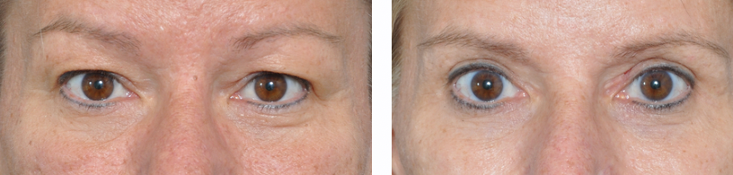 Before-and-after photos of a person's eyes showing the effects of an eyelid lift surgery.