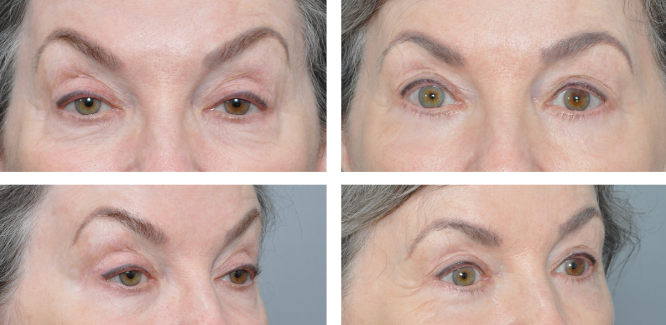 Four images of a person's eyes, showing before and after treatment for droopy eyelids.