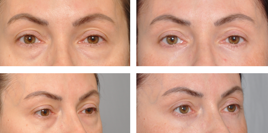 Four panels showing before-and-after of a person's eyes and eyebrows; the 