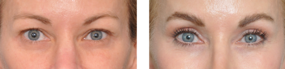 Before and after photos of a person's face after cosmetic procedure, showing smoother skin and less noticeable wrinkles.