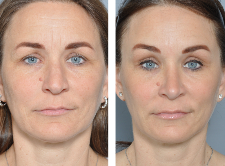 Before and after photos of a woman's face, showing cosmetic improvements.