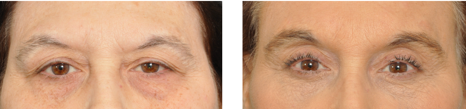 Close-up of eyes before and after an eyelid lift procedure. Dark eyes, brow lift.