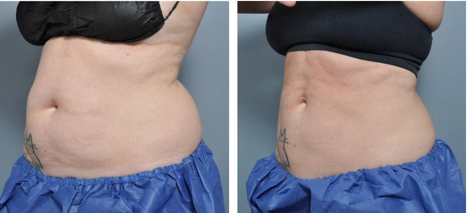 Side-by-side view showing a person's abdomen before and after a body contouring procedure.