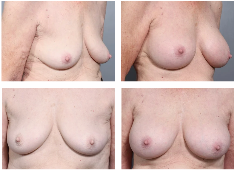 Four-panel comparison of a person's breasts before and after a surgical procedure.