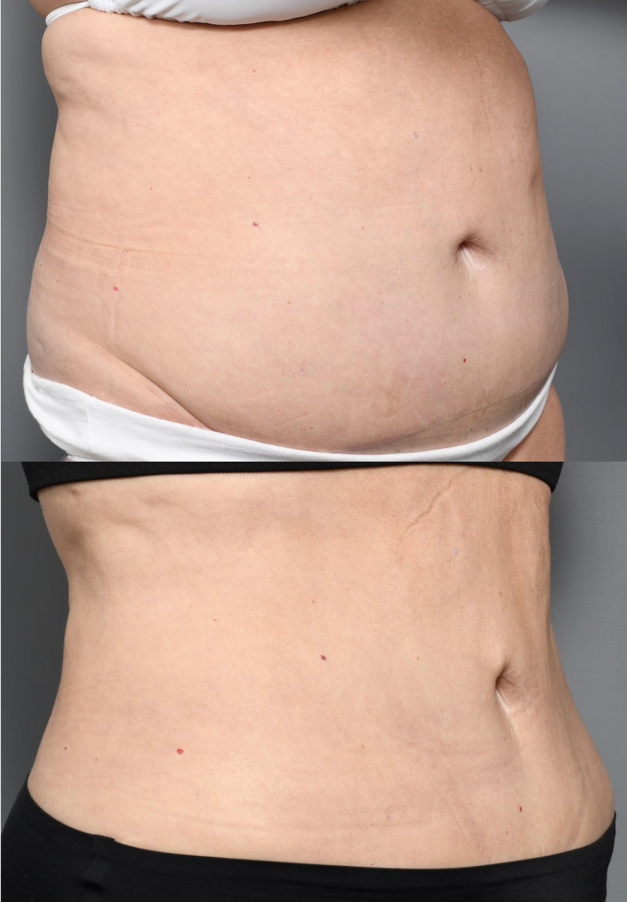 Before and after photos showing liposuction results