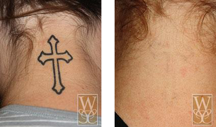 Before and after photos: tattoo of a cross on nape of neck fades after laser removal.