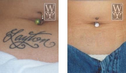 Before-and-after of tattoo removal near navel; 