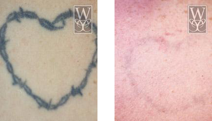 Before and after photo of tattoo removal. The left shows a barbed wire heart tattoo, and the right shows faded skin.