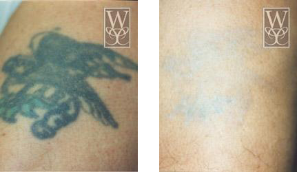 Tattoo removal: Before and after. Large black tattoo of bird on skin, faded to faint blue after treatment.