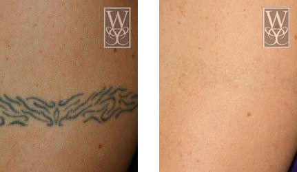 Before and after tattoo removal on back; green tribal design fades.