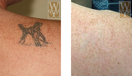 Before and after photos of tattoo removal on shoulder. Tattoo of insect before; clear skin after.