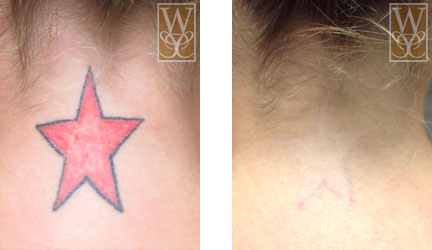 Before-and-after of tattoo removal: Red star tattoo on neck fades significantly after treatment.