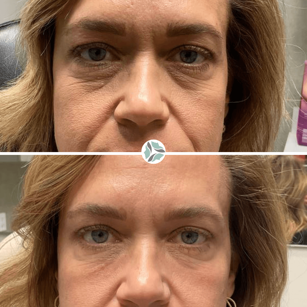 Before and after photos of a woman's eyes. Top: dark circles, wrinkles. Bottom: smoother skin, brighter eyes.
