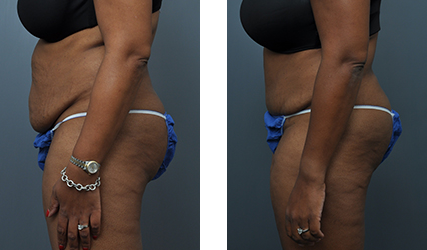 Tummy Tuck 5 before/after with Dr. Emile Picarella with Williamson Cosmetic Center in Baton Rouge